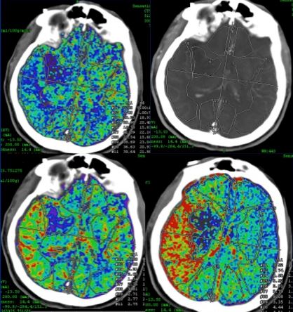ct perfusion stroke
